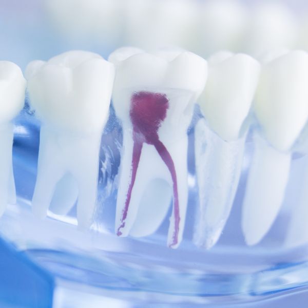 Behandlung zum Zahnerhalt