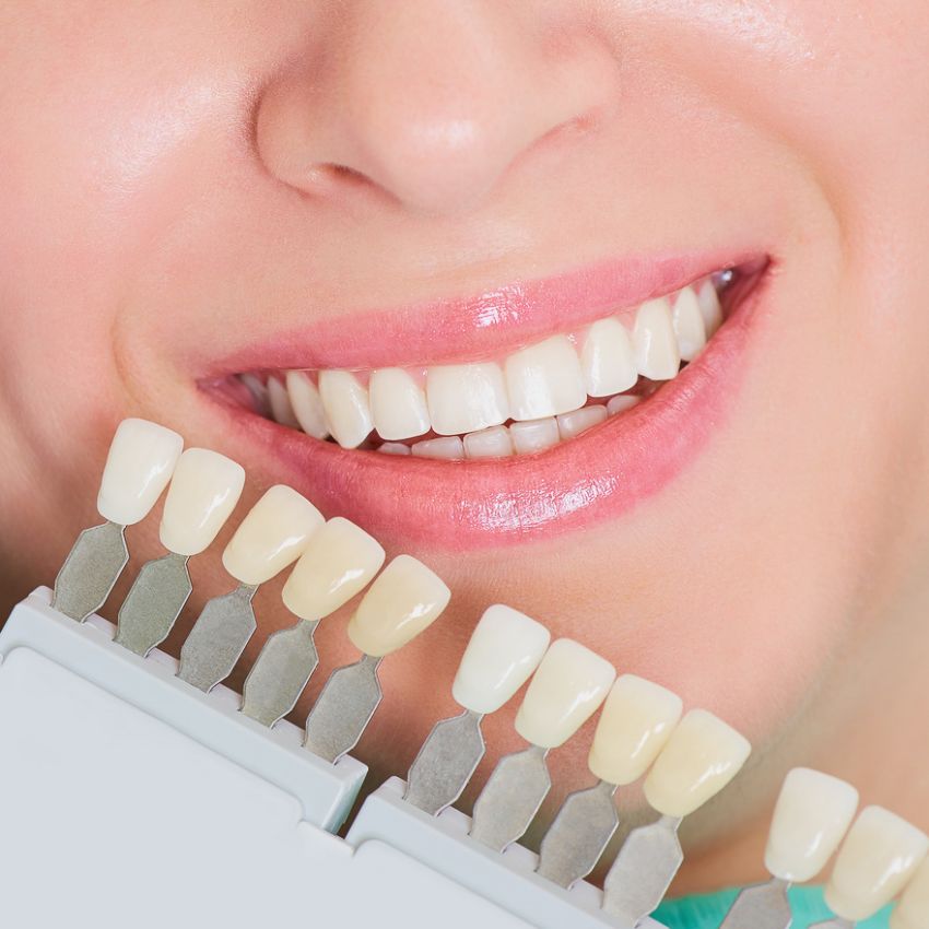 Zahnbleaching Aufhellung