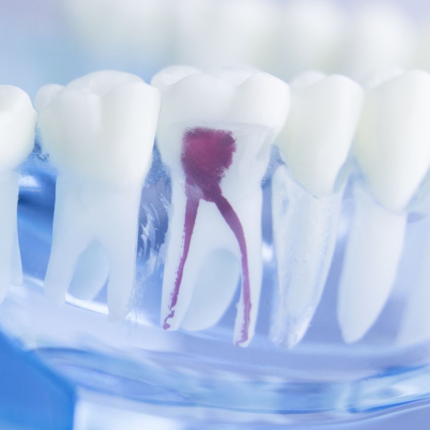 Beispielbild für Wurzelkanalbehandlung